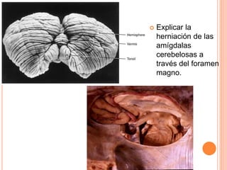  Explicar la
herniación de las
amígdalas
cerebelosas a
través del foramen
magno.
 