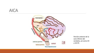 AICA
Porción anterior de la
cara inferior del
cerebelo, así como VII
y VIII PC
 