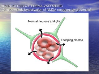 BRAIN: CEREBRAL EDEMA-VASOGENIC (Caused mainly by activation of NMDA receptors by glutamate) 