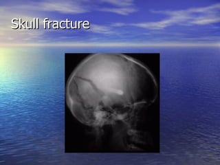 Skull fracture 