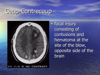 Coup-Contrecoup focal injury consisting of contusions and hematoma at the site of the blow, opposite side of the brain 