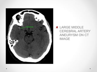 LARGE MIDDLE
CEREBRAL ARTERY
ANEURYSM ON CT
IMAGE
 