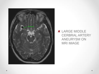 LARGE MIDDLE
CERBRAL ARTERY
ANEURYSM ON
MRI IMAGE
 