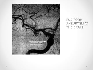 FUSIFORM
ANEURYSM AT
THE BRAIN
 