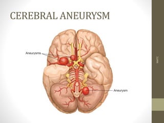 CEREBRAL ANEURYSM
NMTC
 