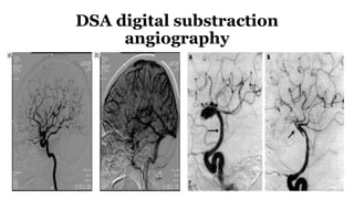 DSA digital substraction
angiography
 