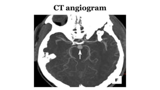 CT angiogram
 