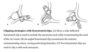 Clipping strategies with fenestrated clips. (A) Here, a side-deflected
fenestrated clip is used to occlude the aneurysm neck while reconstructing the neck
of the A2 vessel. (B) An angled fenestrated clip reconstructs the anterior
communicating artery, saving perforating branches. (C) Two fenestrated clips are
used to clip a wide neck aneurysm.
 