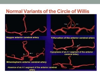 Normal Variants of the Circle of Willis
 