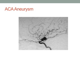 ACAAneurysm
 
