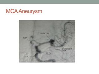 MCAAneurysm
 