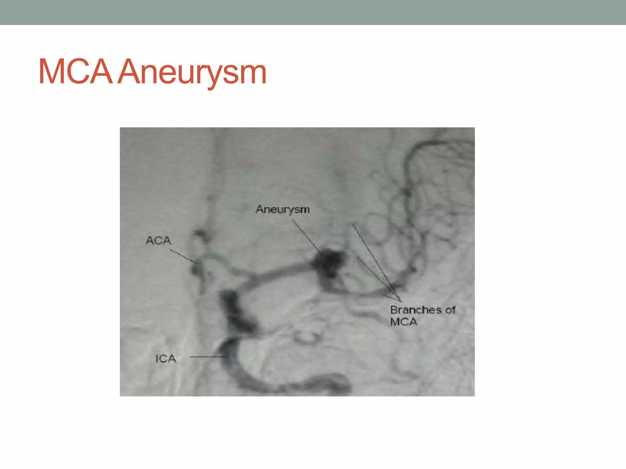 MCAAneurysm
 