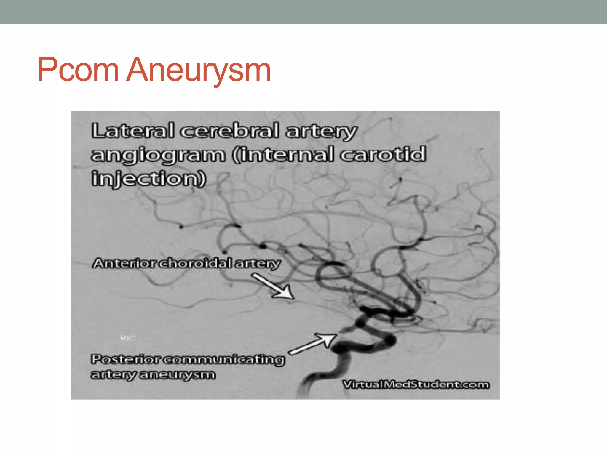 Pcom Aneurysm
 