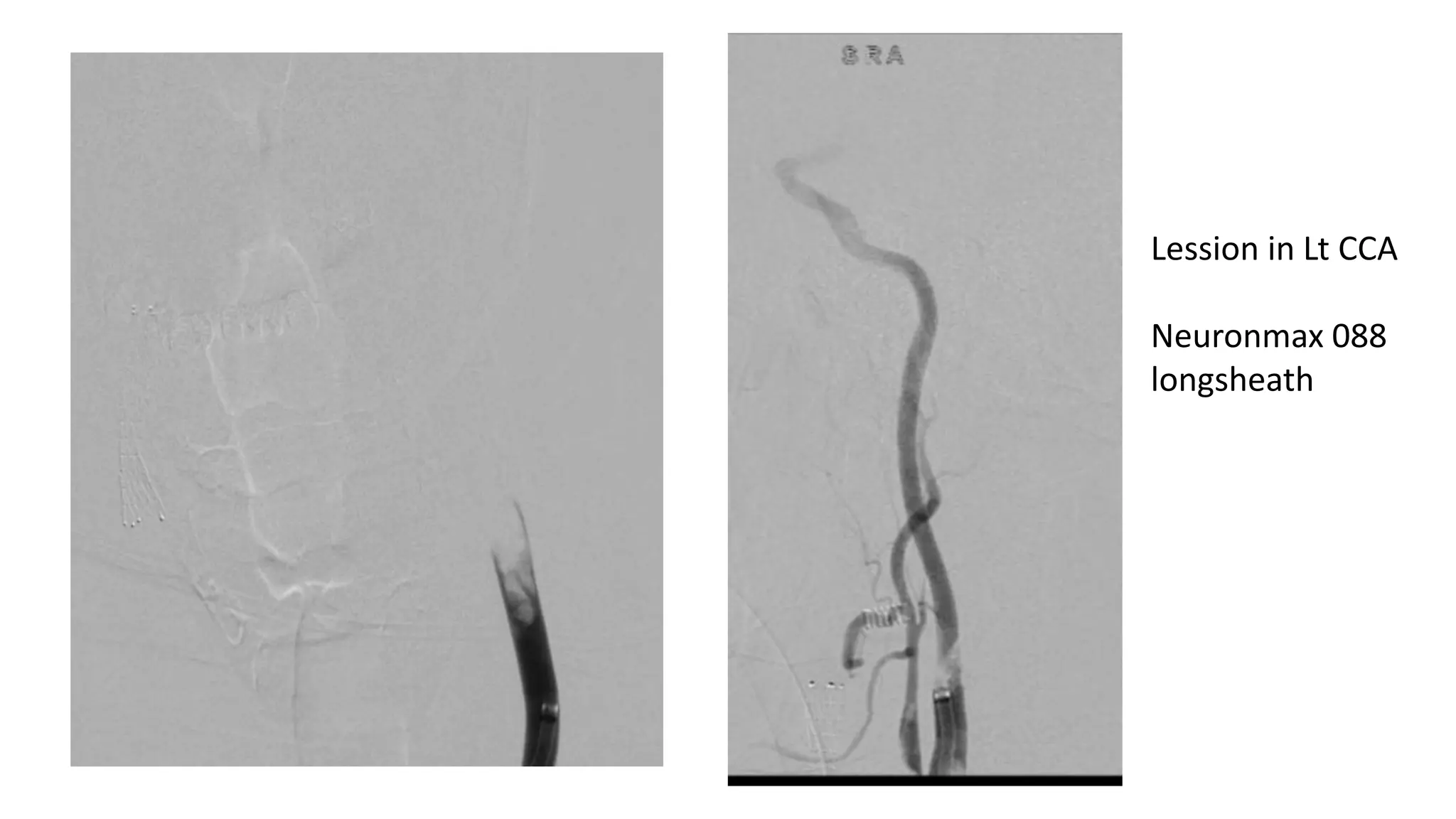 CEREBRAL ANGIOPLASTY IN ACUTE ISCHEMIC STROKE | PPTX