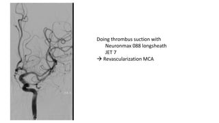 CEREBRAL ANGIOPLASTY IN ACUTE ISCHEMIC STROKE | PPTX