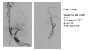 CEREBRAL ANGIOPLASTY IN ACUTE ISCHEMIC STROKE | PPTX