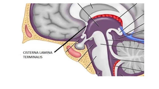 cerebral cisterns for radiology dnb .pptx