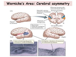 Wernicke’s Area: Cerebral asymmetry
 