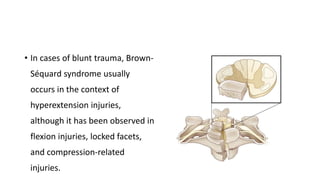 • In cases of blunt trauma, Brown-
Séquard syndrome usually
occurs in the context of
hyperextension injuries,
although it has been observed in
flexion injuries, locked facets,
and compression-related
injuries.
 