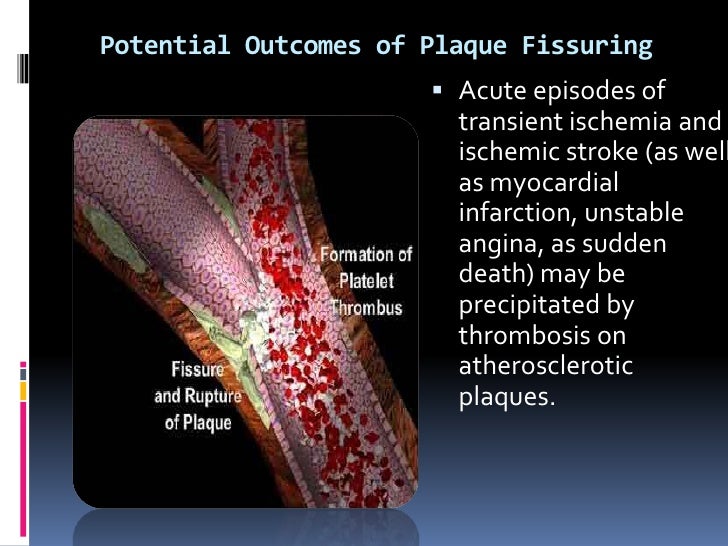 STROKE LECTURE By Arlyn M. Valencia, M.D. Associate Professo Universi…