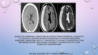 SUBACUTE SUBDURAL HEMATOMA IN A RIGHT FRONTOPARIETAL CONCAVITY.
CT SCAN (CT) SHOWS AN ISOATTENUATING-TO-HYPOATTENUATING
SUBDURAL HEMATOMA. BOTH T1-WEIGHTED (T1W) AND T2-WEIGHTED (T2W)
MR IMAGES SHOW HIGH SIGNAL INTENSITY SUGGESTIVE OF A LATE
SUBACUTE HEMORRHAGE.
2nd year: group(26) -2017- Anatomy department
 