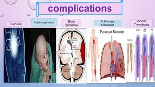 complications
Seizures
Hydrocephalus Brain
Herniation
Pulmonary
Embolism
Venous
Thrombosis
 