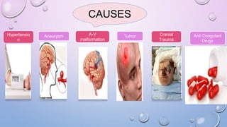 CAUSES
Hypertensio
n
Aneurysm A-V
malformation
Tumor Cranial
Trauma
Anti Coagulant
Drugs
 