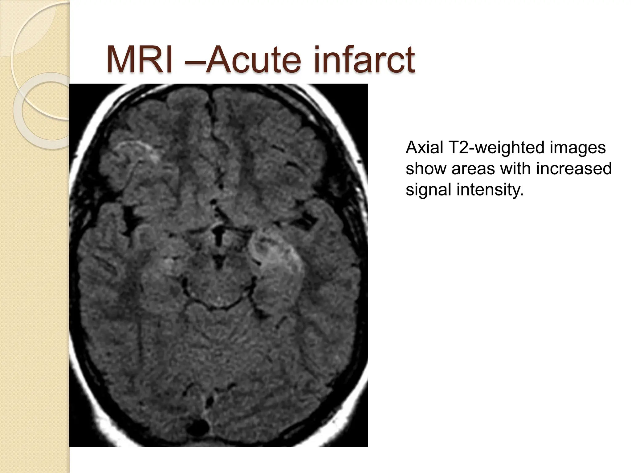 Cerebral Infarcts . pptx | PPTX