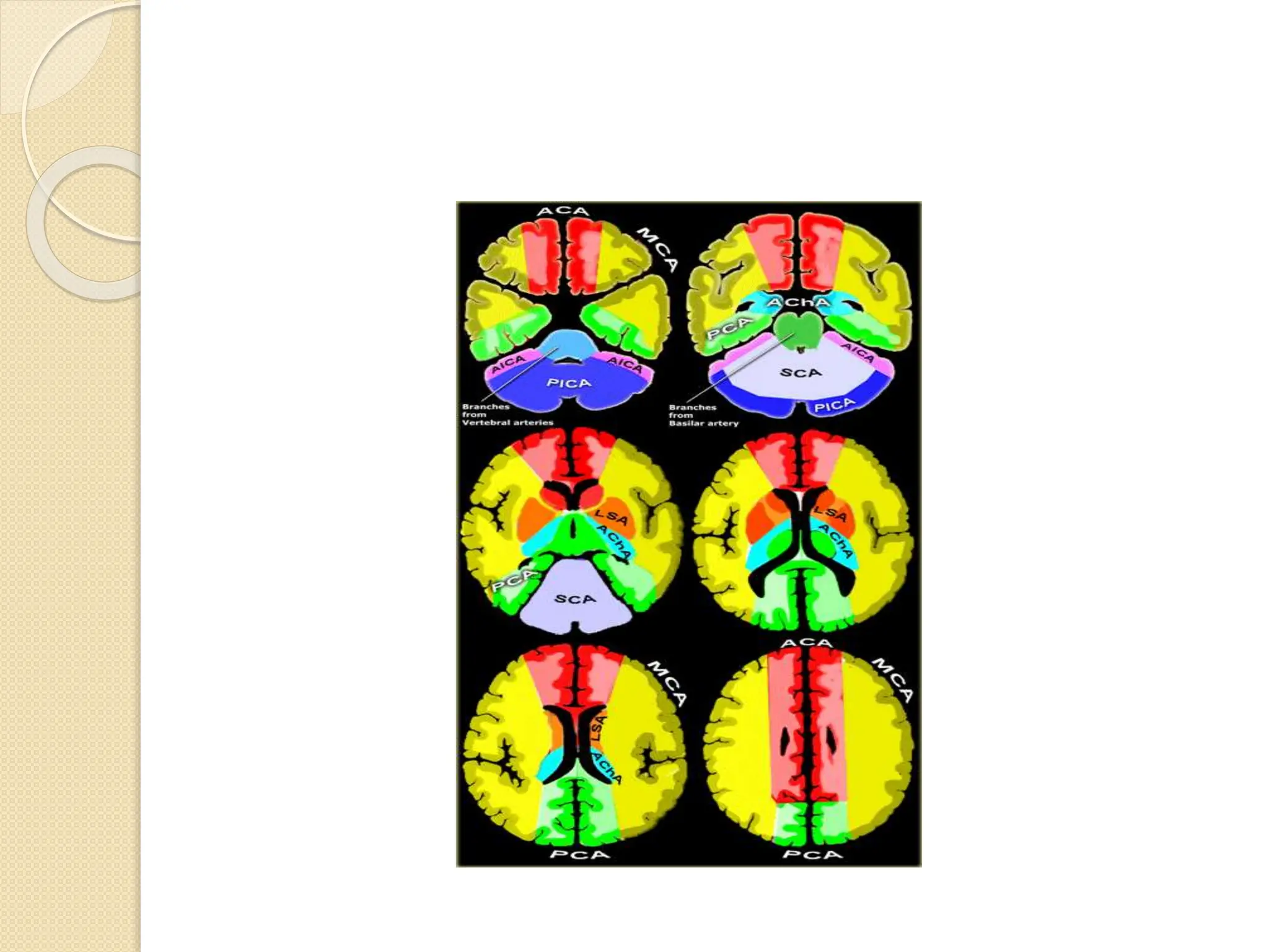 Cerebral Infarcts . pptx | PPTX