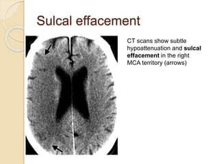 Sulcal effacement
CT scans show subtle
hypoattenuation and sulcal
effacement in the right
MCA territory (arrows)
 