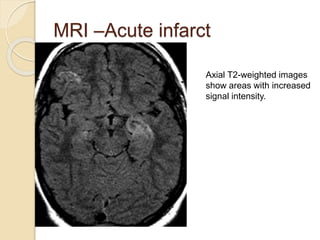MRI –Acute infarct
Axial T2-weighted images
show areas with increased
signal intensity.
 