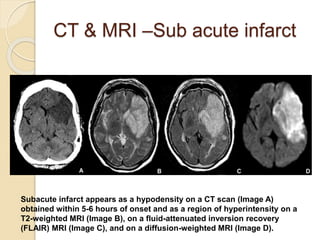 CT & MRI –Sub acute infarct
Subacute infarct appears as a hypodensity on a CT scan (Image A)
obtained within 5-6 hours of onset and as a region of hyperintensity on a
T2-weighted MRI (Image B), on a fluid-attenuated inversion recovery
(FLAIR) MRI (Image C), and on a diffusion-weighted MRI (Image D).
 