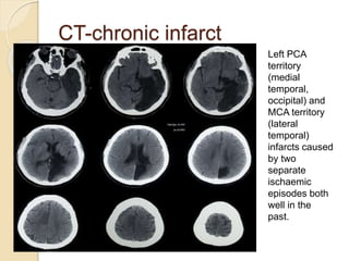 CT-chronic infarct
Left PCA
territory
(medial
temporal,
occipital) and
MCA territory
(lateral
temporal)
infarcts caused
by two
separate
ischaemic
episodes both
well in the
past.
 