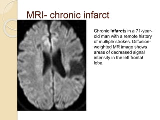MRI- chronic infarct
Chronic infarcts in a 71-year-
old man with a remote history
of multiple strokes. Diffusion-
weighted MR image shows
areas of decreased signal
intensity in the left frontal
lobe.
 