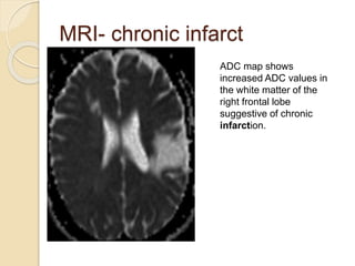 MRI- chronic infarct
ADC map shows
increased ADC values in
the white matter of the
right frontal lobe
suggestive of chronic
infarction.
 