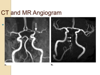 CT and MR Angiogram
 Identifies occlusions, stenosis, status of
Collaterals
 