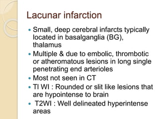 Lacunar infarction
 Small, deep cerebral infarcts typically
located in basalganglia (BG),
thalamus
 Multiple & due to embolic, thrombotic
or atheromatous lesions in long single
penetrating end arterioles
 Most not seen in CT
 Tl WI : Rounded or slit like lesions that
are hypointense to brain
 T2WI : Well delineated hyperintense
areas
 
