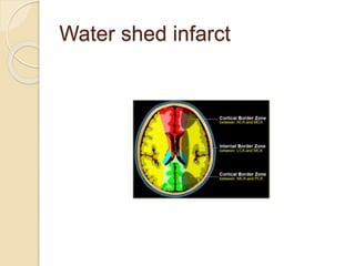 Water shed infarct
 