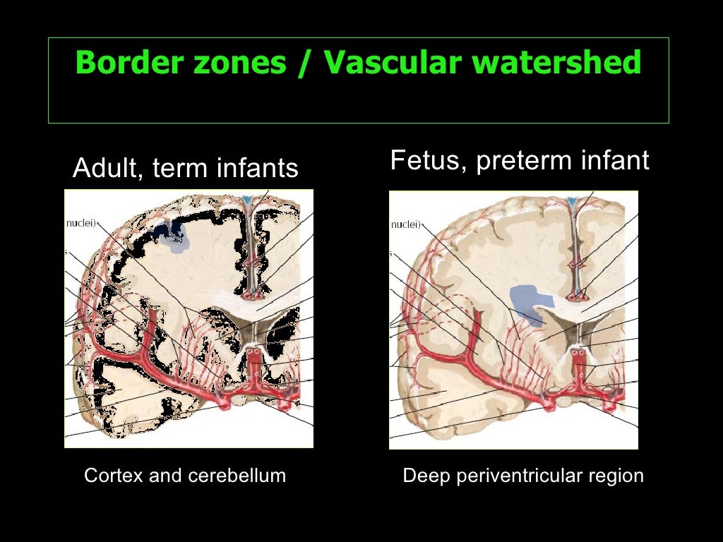 Cerebral Ischemia