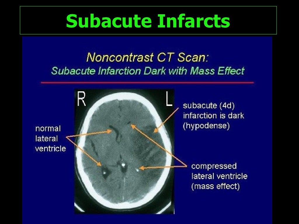 cerebral-ischemia