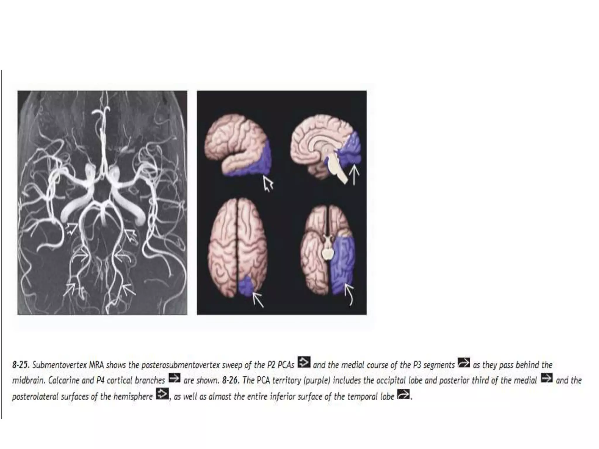 Imaging in cerebral ischemia | PPT