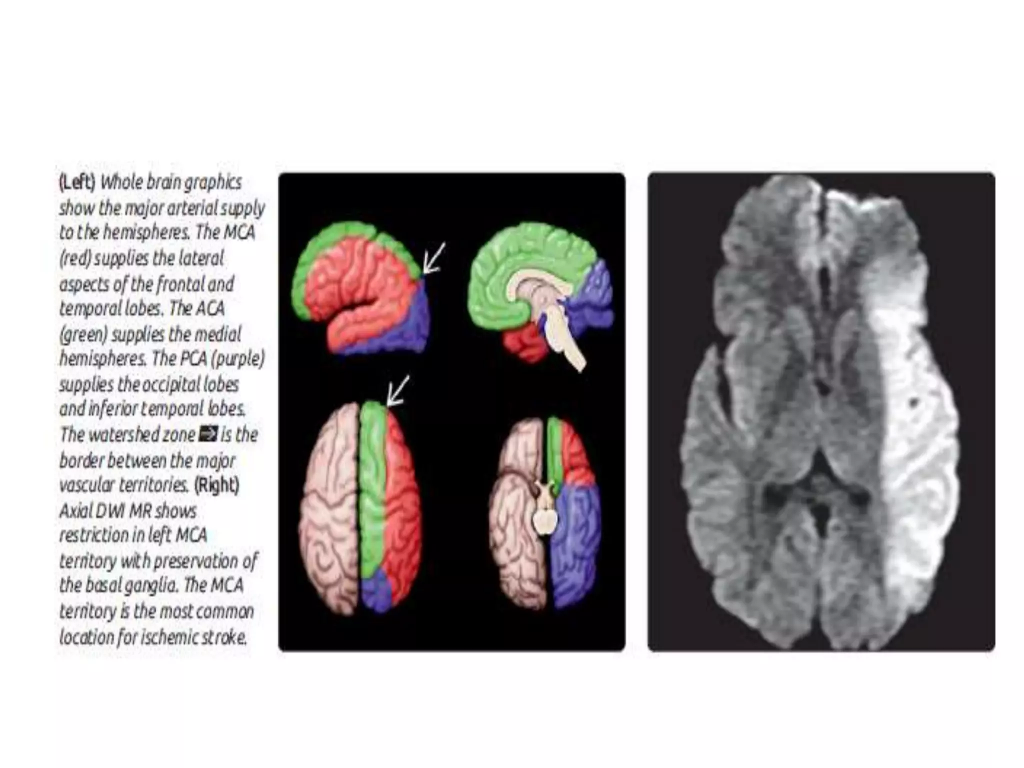 Imaging in cerebral ischemia | PPT