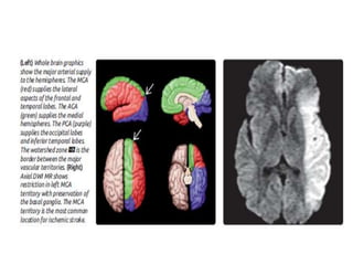 Imaging in cerebral ischemia | PPT
