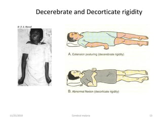 Decorticate Riidity Cerebral Malaria | PPT