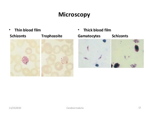 p blood test smear Cerebral Malaria