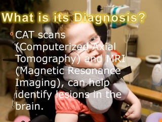 
    CAT scans
    (Computerized Axial
    Tomography) and MRI
    (Magnetic Resonance
    Imaging), can help
    identify lesions in the
    brain.
 