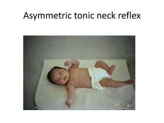 Asymmetric tonic neck reflex 
 