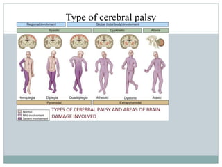 Type of cerebral palsy
 