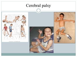 Cerebral palsy
 