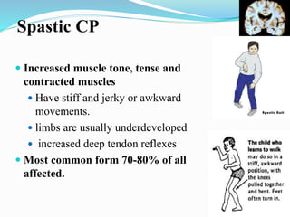 Cerebral Palsy Muscle Tone : Features of CP – ZOPP